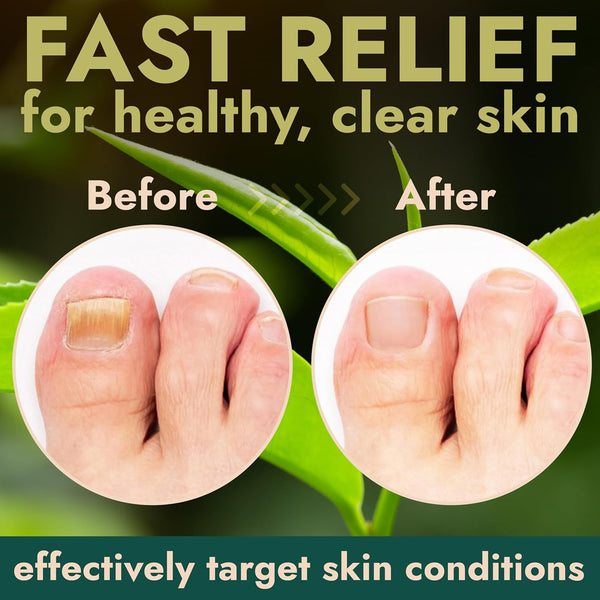 Nail Fungus Treatment with Tea Tree Oil for Fungal Nail & Toenail Repair