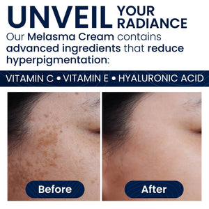 Melasma Treatment for Face & Body Cream: Reduces Dark Spots, Age Spots and Promotes Even - Toned Skin with Vitamin C - Pharmlitalia